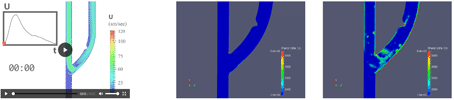 hemodynamics in a stenosed arteriovenous fistula